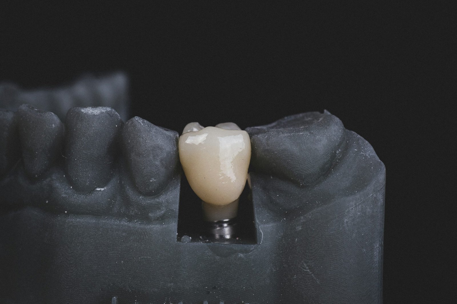 Implant dentaire