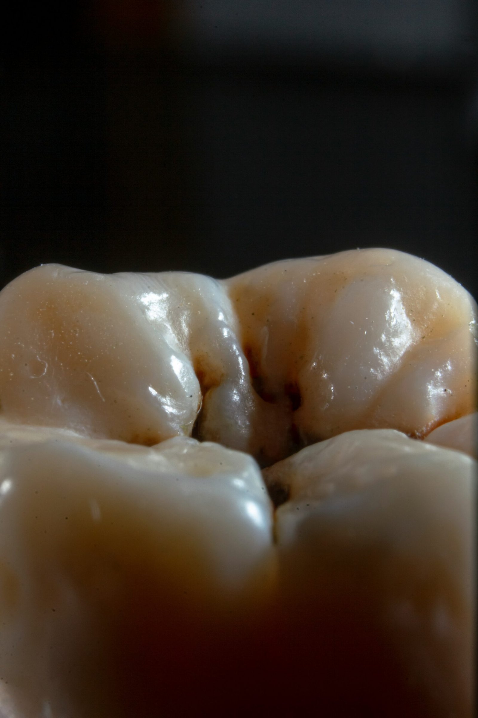 Dents de sagesse