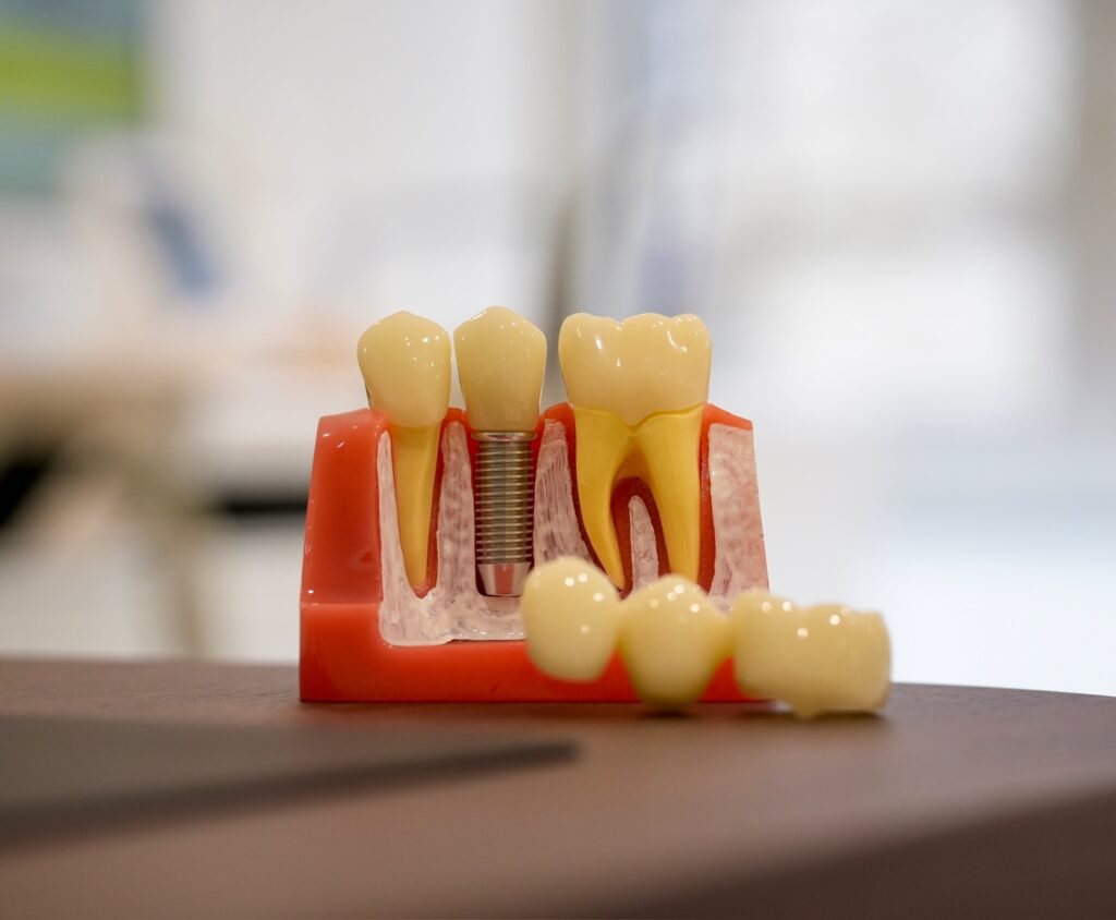 Implantologie et greffe osseuse